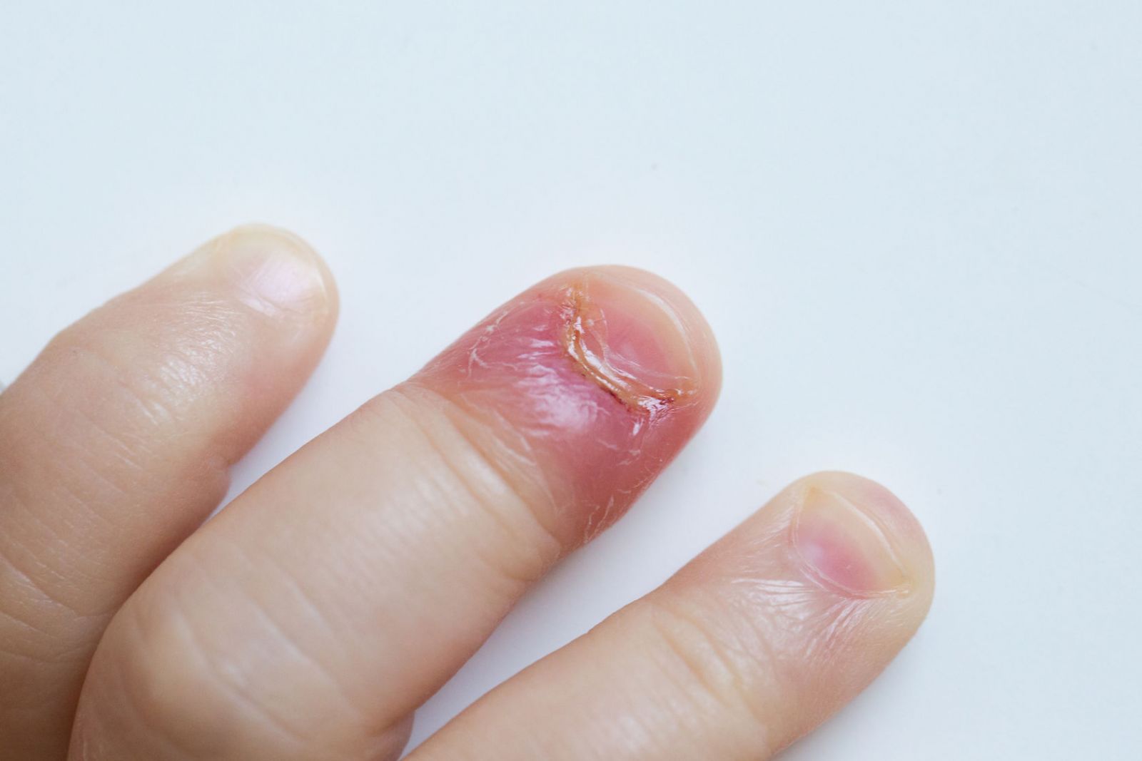 A bőrgombák kezelése a körmök alatt | Onycosolve