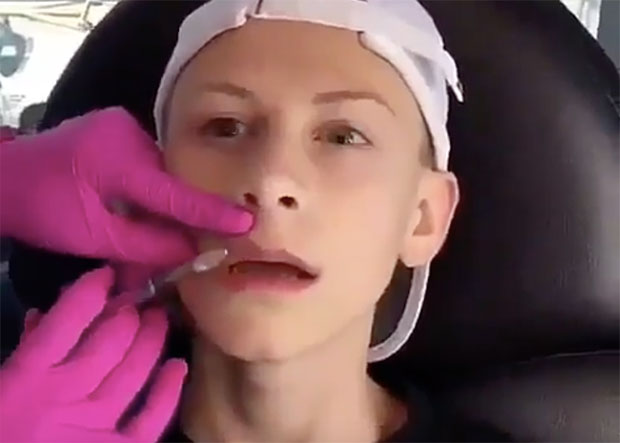 Szájfeltöltéséről posztolt videót a tinifiú