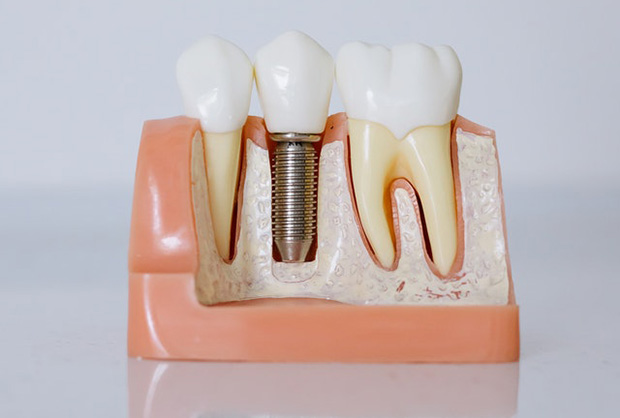fogimplantátum modern fogpótlás 