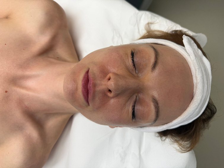 Scarlet RF mikrotűs kezelés után