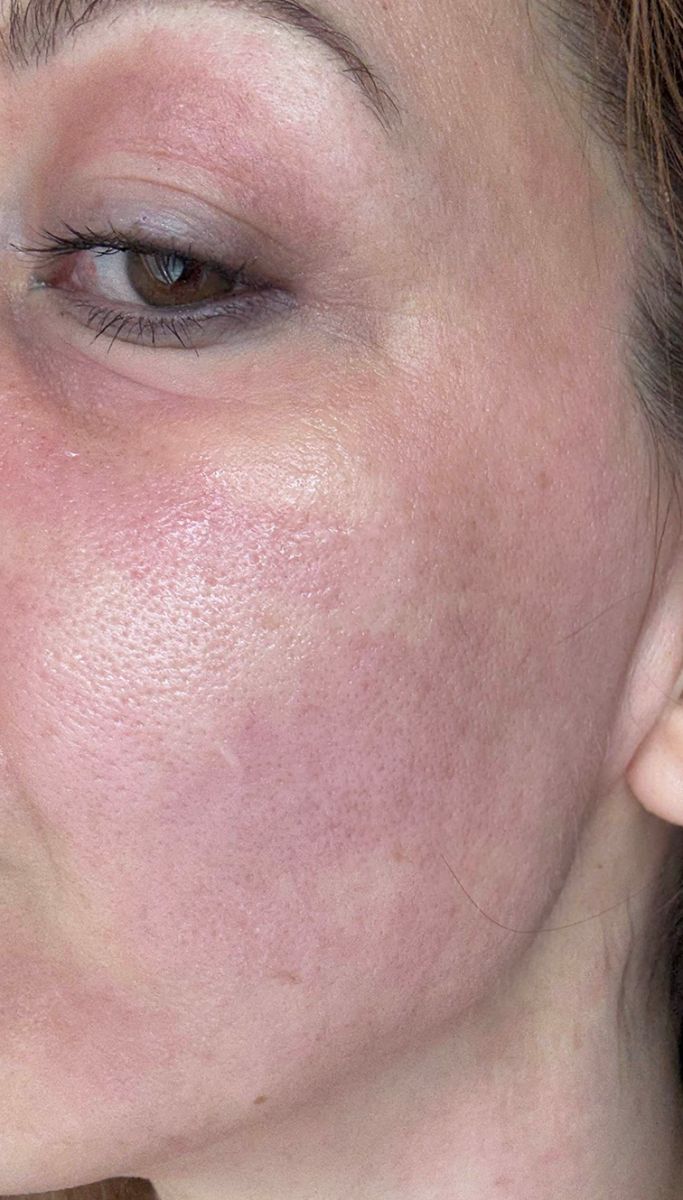 Scarlet RF mikrotűs kezelés után