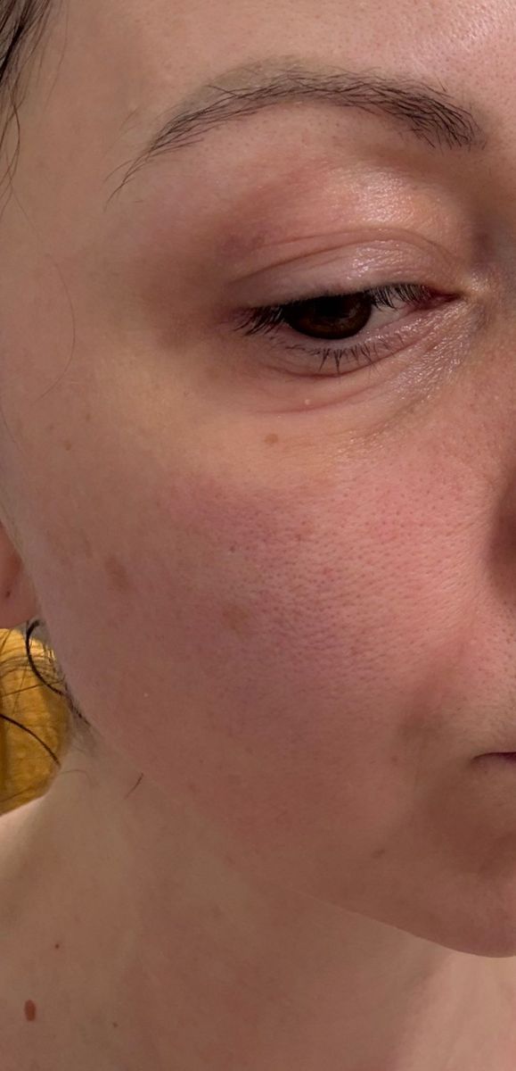 Scarlet Rf kezelés után néhány órával