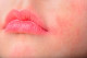 Perioriorális dermatitisz - Inkább a száj és a szemhéj körül jellemzőek, piros, körbehatárolt foltok ezek, melyek leggyakrabban hormonális változások hatására jelennek meg. Emésztési zavarok is állhatnak a hátterében, így ha ilyennel találkozunk, akkor mindenképp érdemes felkeresni egy bőrgyógyászt.