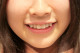 A japánoknál a tökéletlen fogsor a divat, ahol a fogak lehetőleg kilógnak. Sok nő képes fizetni is érte, hogy ilyen lehessen mosolya.