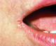 Repedések a száj sarkában

Amikor a nyál beszorul a száj sarkába, kiszárad a bőr, amely ettől kirepedezhet. Lehet, hogy gyakran nyalogatod ajkaid, a meleg és nedves sarkok pedig tökéletes feltételeket biztosítanak a fertőzésekhez, ami a repedések leggyakoribb oka. Ha túl gyakran fordul elő, érdemes felkeresni az orvost.