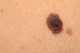 A bőrrák legagresszívebb fajtája, a melanoma a test számos pontján megjelenhet, így sajnos a lábfejen is.