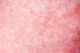 A skarlát átlagos lappangási ideje 3 nap, a vezető tünetek a következők: hidegrázás, torokfájás, nehezített nyelés, magas láz. A nyelv eleinte fehér színű, majd néhány nap múlva, amikor a lepedék letisztul, jól észrevehetővé válik vörösessége. Három napon belül bőrtünetek jelentkeznek (a nyakon, a mellkason, a hason, aztán a végtagokon). A kiütés apró elemekből áll, és gyakran előfordul, hogy csak a lágyékon jelenik meg. A skarlátot napjainkban elsősorban penicillinnel kezelik, amit általában 10 napig kell szedni, de olykor más gyógykészítmény is hatásos lehet. Az antibiotikumos kezelést általában láz- és fájdalomcsillapítás egészíti ki. Kiemelten fontos, hogy  kellő mennyiségű folyadékot vigyünk be a szervezetbe a megemelkedett folyadékigény miatt - írja a Házipatika.com.