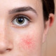 Elszíneződések

A bőr elszíneződései, legyen az vörös, barna, vagy fehér, általában valamilyen háttérben megbúvó egészségügyi dologra utalnak. „A vörösség gyakran gyulladást jelez, a barna pedig a napkárosodással kapcsolatos pigmentációs változásokra utalhat, míg a kékes elszíneződések akár érrendszeri problémák jelei is lehetnek” – mondja Dr. Brauer. Szintén fontos megemlíteni, hogy a diabétesz bizony sötét foltokat is eredményezhet a bőr felületén, így ezeket sem szabad félvállról venni.