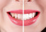 Fehérítheti a fogakat: Az érett banán&nbsp;rengeteg káliumot tartalmazhat, ami csökkenthati&nbsp;a fogak sárgás elszíneződését, melyeket többek között a kávé és a színes gyümölcsök&nbsp;okozhatnak.&nbsp;Moss fogat, majd jó alaposan öblítsd ki a szádat. A héj belső, fehér felével dörzsöld át a kívánt részt 2 percig. Napi rendszerességgel csodás változást eredményezhet!&nbsp;
