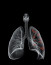 Mint írták, konzorciumvezetőként az OKPI a krónikus légúti gyulladással járó tüdőbetegségek, így a krónikus obstruktív tüdőbetegség (COPD), az asztma és a cisztás fibrózis (CF) gyulladásos folyamatait vizsgálja modern molekuláris technológiákkal. A kutatások egyik célja olyan biomarkerek keresése, amelyek lehetővé teszik az eltérő gyulladásos folyamatokkal érintett betegek állapotsúlyosbodásának előrejelzését, valamint annak megállapítását, hogy milyen rizikója van tüdődaganatok kialakulásának a pácienseknél. A különböző gyulladásos folyamatok molekuláris vizsgálatai nemcsak egy betegség kialakulásának és fejlődésének jobb megértését szolgálják, hanem a jövőben új gyógyszeres terápiás célpontok és új diagnosztikai módszerek kifejlesztését is lehetővé teszik - fejtették ki.
