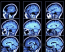 Az orvosok koponya CT-vizsgálatot végeztek és ekkor fedezték fel a ciszta okozta elváltozások egyértelmű jelenlétét az agy mindkét oldalán.

