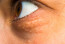 A sárgás bőrelváltozás a szem környékén vagy épp a szemhéjon utalhat daganatra vagy a szervezet zsíranyagcseréjének zavarára is, de a szakértők megállapították, hogy akinél fennáll a xanthelasma palpebrarum nevű elváltozás, azoknál 48%-kal magasabb a szívproblémák kialakulásának kockázata.
