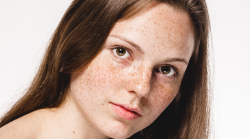 Apró, barna foltok az arcon - Így kezelheted az egyik leggyakoribb bőrproblémát, a hiperpigmentációt